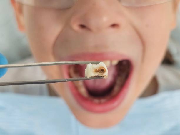 Best Emergency Dental Care for Broken or Chipped Teeth in Kirksville, MO